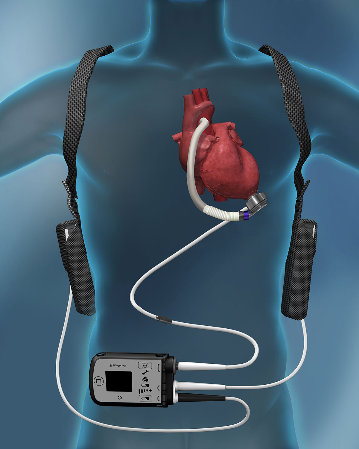 Left Ventricular Assist Device (LVAD), kunsthart, steunhart
