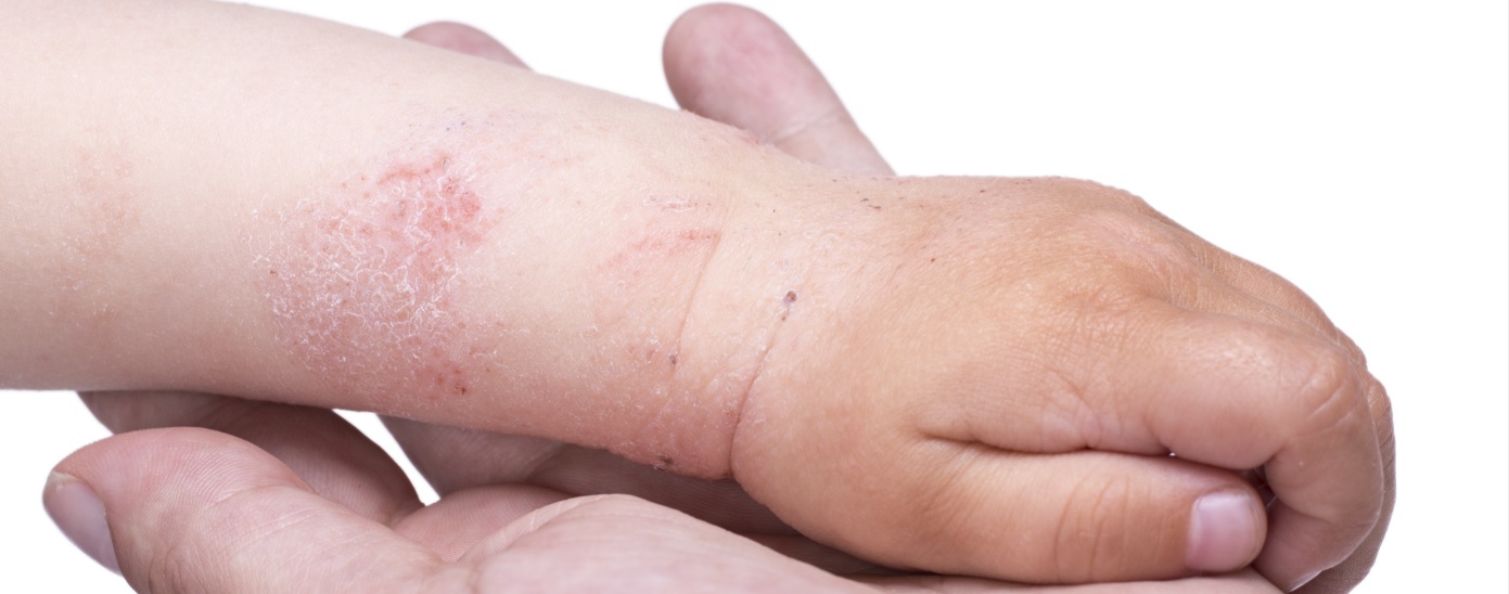 1200 Kind met eczeem