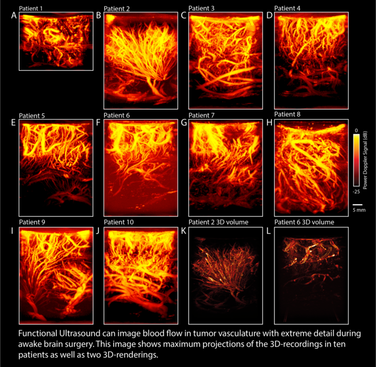 illustratie hersenactiviteit CUBE