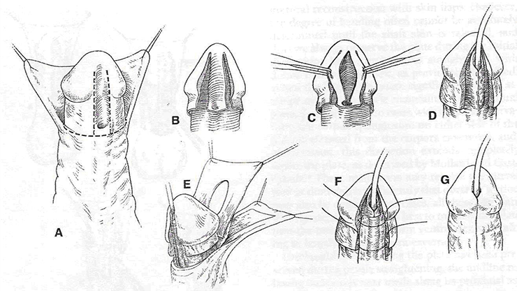afbeelding operatietechniek van de plasbuis van penis. Hypospadiecorrectie