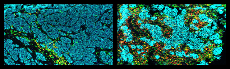 Urothelial cancer picture.