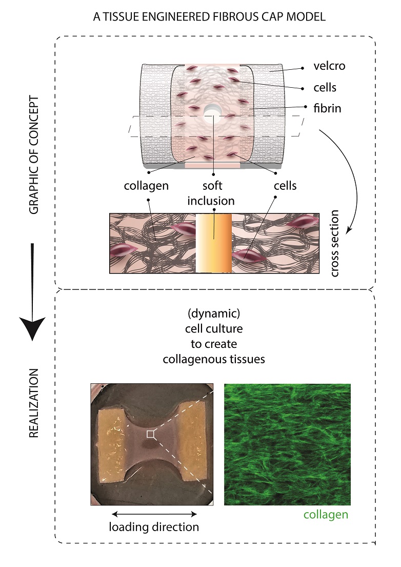 Human disease model for atherosclerosis