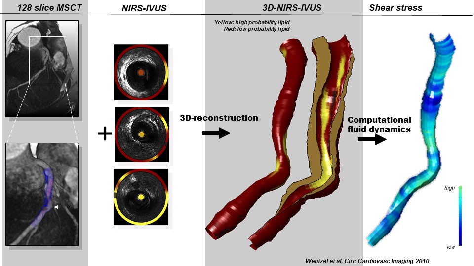 Atherosclerosos Biomechanics