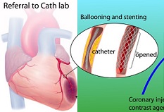 QUANTO-3D QUANTO-3D-myocardial-perfusion-imaging-with-echography