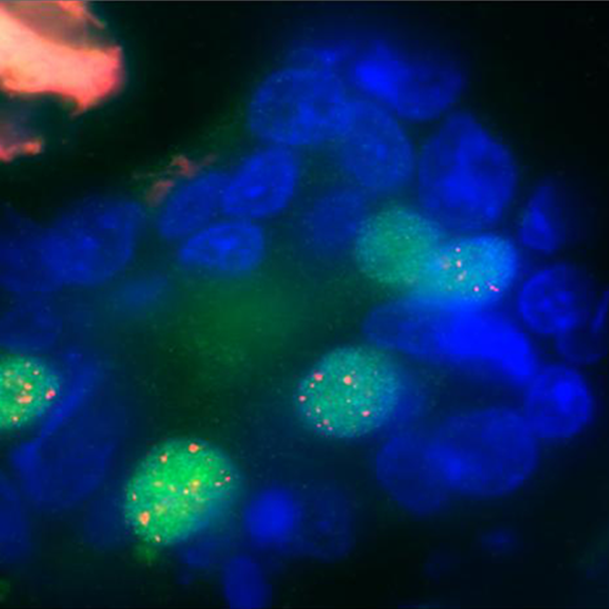 Breast tumor