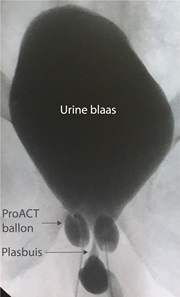 prostaatkanker proactballon