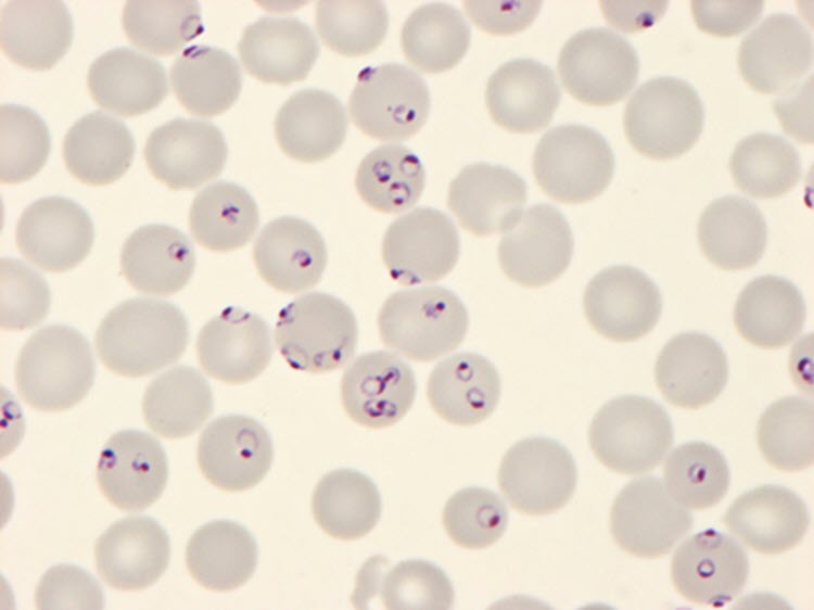 Giemsa stained thin blood-smear with Plasmodium falciparum
