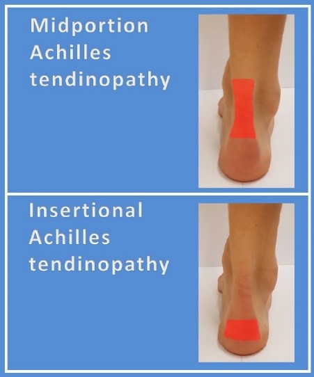 picture achilles pees-Treatment of Achilles tendinopathy 