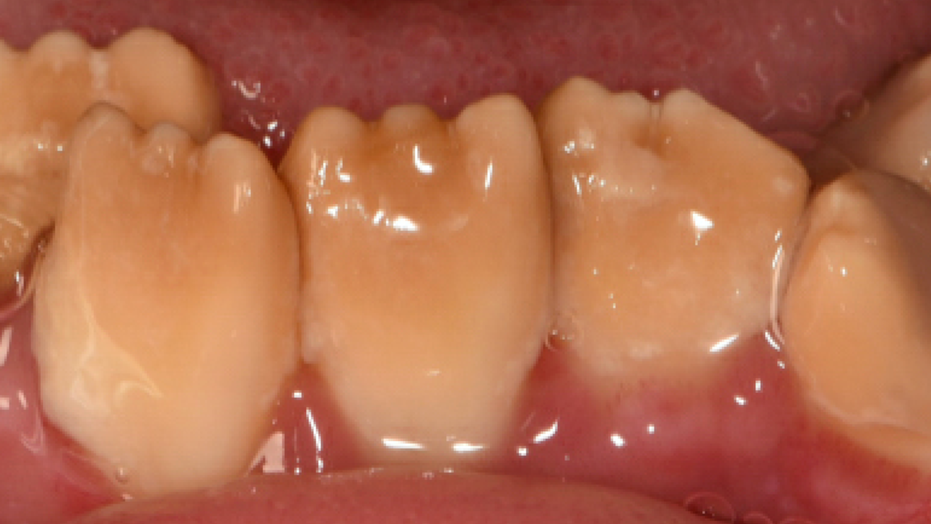 orthodontie afbeelding2